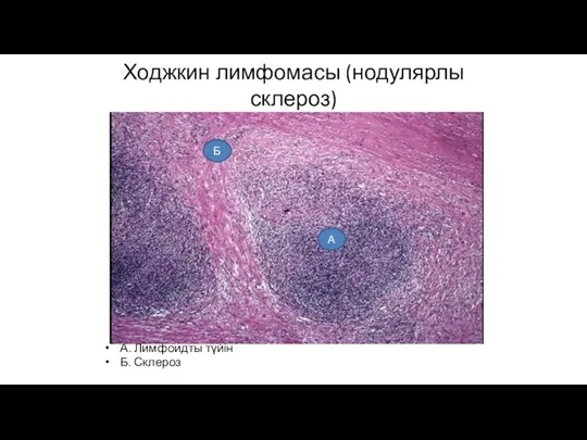 Ходжкин лимфомасы (нодулярлы склероз) А. Лимфоидты түйін Б. Склероз Б А