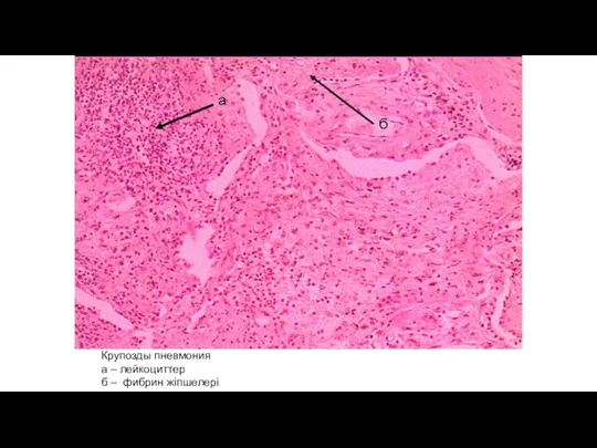 Крупозды пневмония а – лейкоциттер б – фибрин жіпшелері