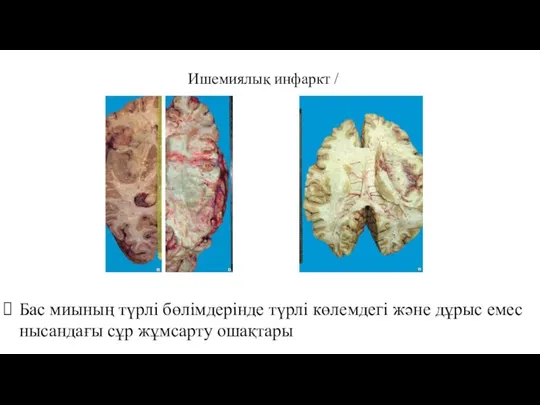 Ишемиялық инфаркт / Бас миының түрлі бөлімдерінде түрлі көлемдегі және дұрыс емес нысандағы сұр жұмсарту ошақтары