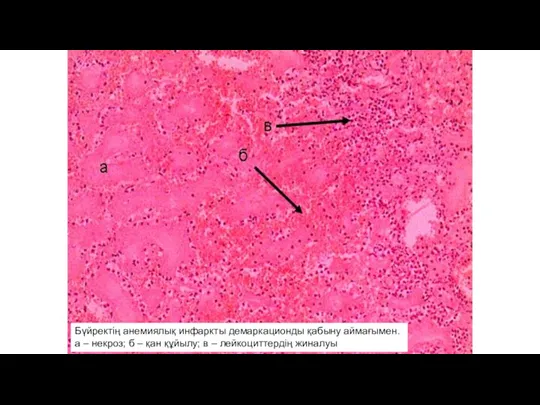 Анемический инфаркт почки с зоной демаркационного воспаления а – некроз; б –
