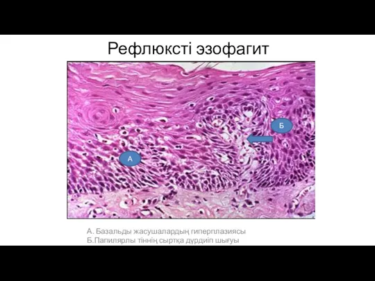 Рефлюксті эзофагит А. Базальды жасушалардың гиперплазиясы Б.Папилярлы тіннің сыртқа дүрдиіп шығуы А Б