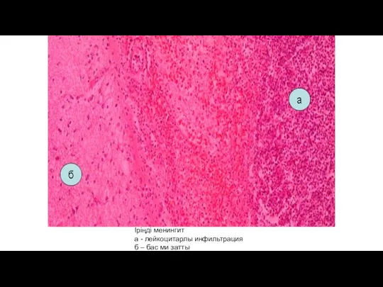 Іріңді менингит а - лейкоцитарлы инфильтрация б – бас ми затты