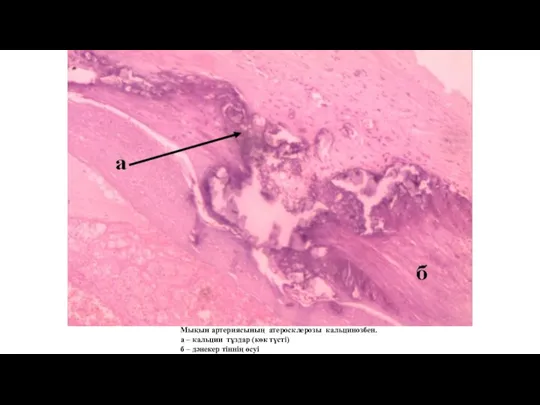 Мықын артериясының атеросклерозы кальцинозбен. а – кальции тұздар (көк түсті) б – дәнекер тіннің өсуі
