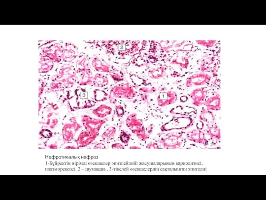 Нефротикалық нефроз 1-Бүйректің иірімді өзекшелер эпитлейлийі жасушаларының кариолизисі, плазморексисі. 2 – шумақша