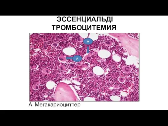 ЭССЕНЦИАЛЬДІ ТРОМБОЦИТЕМИЯ А. Мегакариоциттер А А