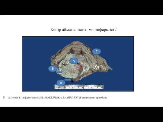 Көпір аймағындағы ми инфарктісі / А. Көпір Б. инфаркт аймағы В. МОЗЖЕЧОК