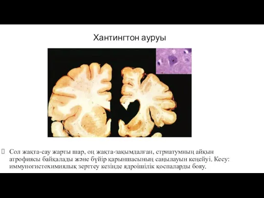 Хантингтон ауруы Сол жақта-сау жарты шар, оң жақта-зақымдалған, стриатумның айқын атрофиясы байқалады