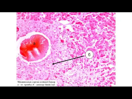 Механикалық сарғаю кезіндегі бауыр а – өт тромбы; б – дәнекер тіннің өсуі