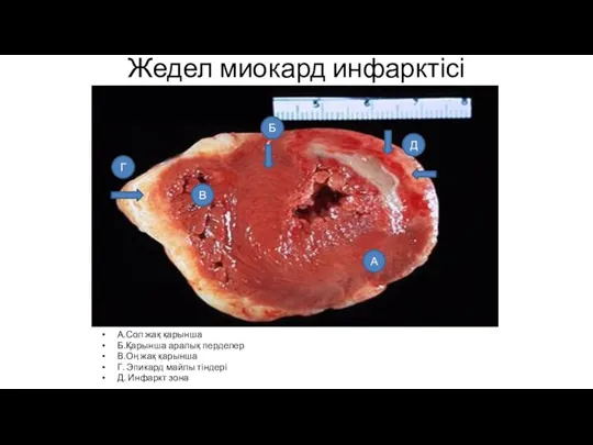 Жедел миокард инфарктісі А.Сол жақ қарынша Б.Қарынша аралық перделер В.Оң жақ қарынша