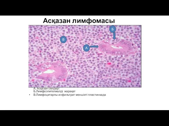 Асқазан лимфомасы А. Асқазан сөлдері Б.Лимфоэпителиалді жарақат В.Лимфоцитарлы инфильтрат меншікті пластинкада В Б А