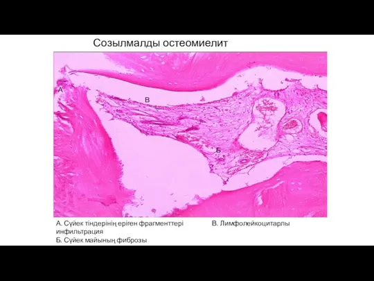 Созылмалды остеомиелит А. Сүйек тіндерінің еріген фрагменттері В. Лимфолейкоцитарлы инфильтрация Б. Сүйек