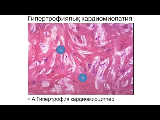 Гипертрофиялық кардиомиопатия А.Гипертрофия кардиомиоциттер А А