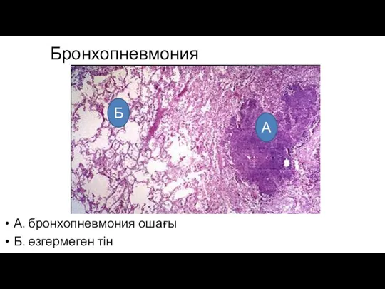 Бронхопневмония А. бронхопневмония ошағы Б. өзгермеген тін Б А