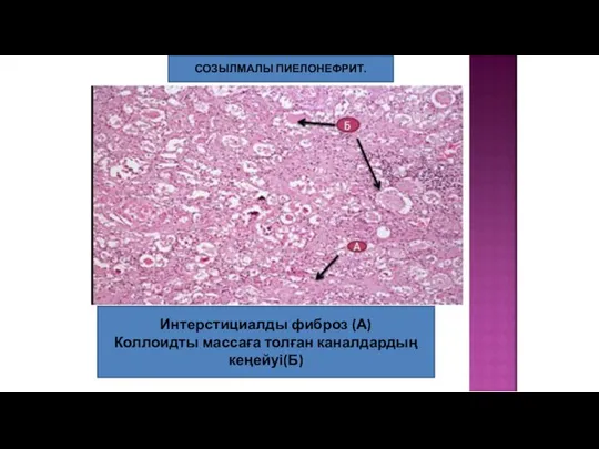 СОЗЫЛМАЛЫ ПИЕЛОНЕФРИТ. Интерстициалды фиброз (А) Коллоидты массаға толған каналдардың кеңейуі(Б)