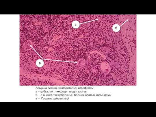 Айырша безінің акцидентальді атрофиясы а – қабықтан лимфоциттердің шығуы б – д