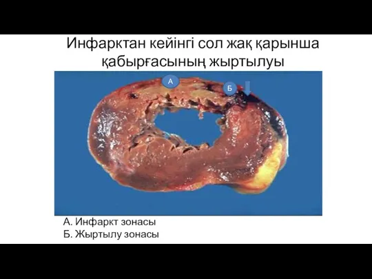 Инфарктан кейінгі сол жақ қарынша қабырғасының жыртылуы А. Инфаркт зонасы Б. Жыртылу зонасы А Б