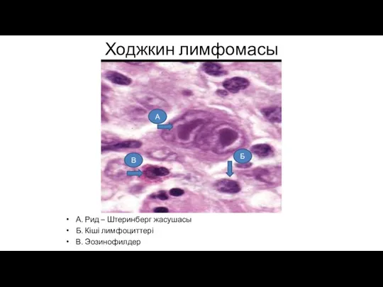 Ходжкин лимфомасы А. Рид – Штеринберг жасушасы Б. Кіші лимфоциттері В. Эозинофилдер В Б А