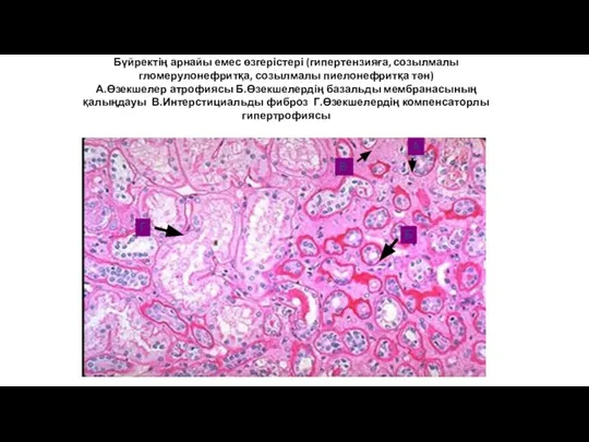 Бүйректің арнайы емес өзгерістері (гипертензияға, созылмалы гломерулонефритқа, созылмалы пиелонефритқа тән) А.Өзекшелер атрофиясы