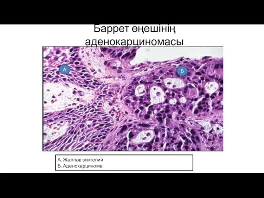 Баррет өңешінің аденокарциномасы А Б А. Жалпақ эпителий Б. Аденокарцинома