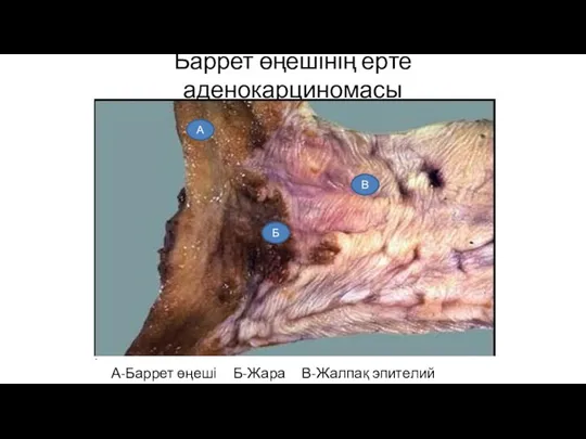 Баррет өңешінің ерте аденокарциномасы А-Баррет өңеші Б-Жара В-Жалпақ эпителий А Б В