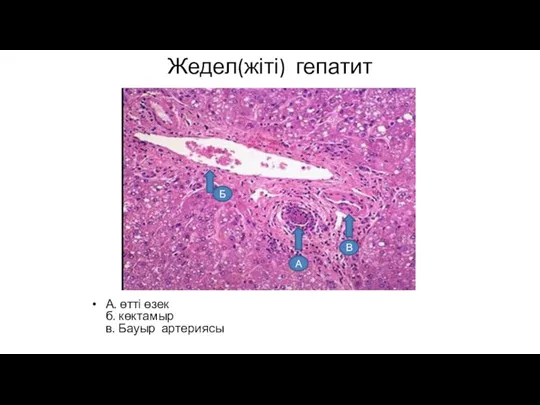 Жедел(жіті) гепатит А. өтті өзек б. көктамыр в. Бауыр артериясы В А Б