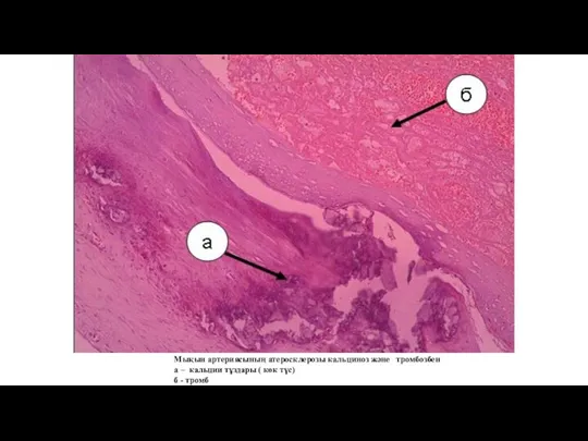 Мықын артериясының атеросклерозы кальциноз және тромбозбен а – кальции тұздары ( көк түс) б - тромб
