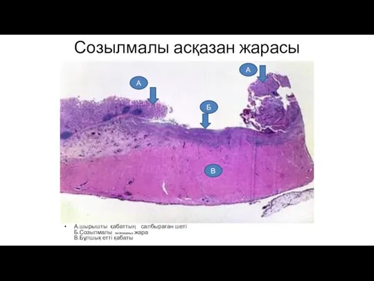 Созылмалы асқазан жарасы А.шырышты қабаттың салбыраған шеті Б.Созылмалы пептикалық жара В.Бұлшық етті