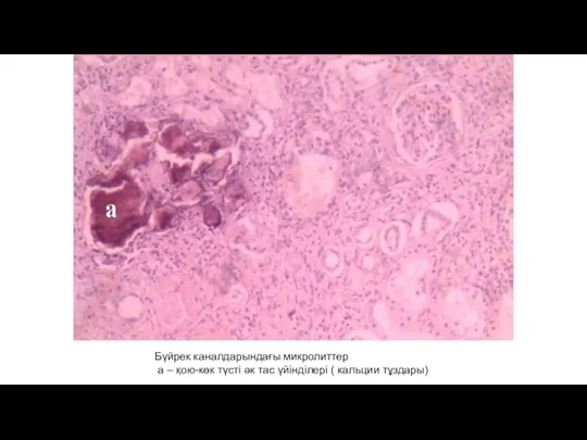 Бүйрек каналдарындағы микролиттер а – қою-көк түсті әк тас үйінділері ( кальции тұздары)