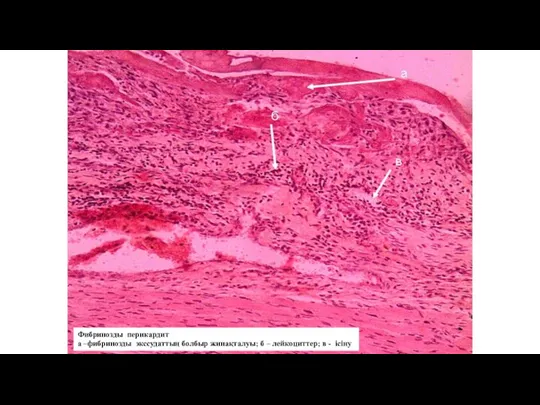 Фибринозды перикардит а –фибринозды экссудаттың болбыр жинақталуы; б – лейкоциттер; в - ісіну