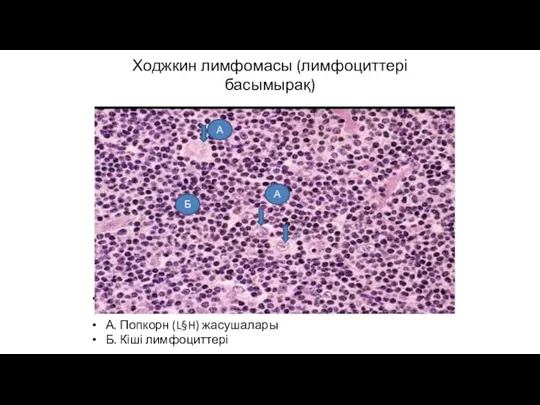 Ходжкин лимфомасы (лимфоциттері басымырақ) А. Попкорн (L§H) жасушалары Б. Кіші лимфоциттері А А Б