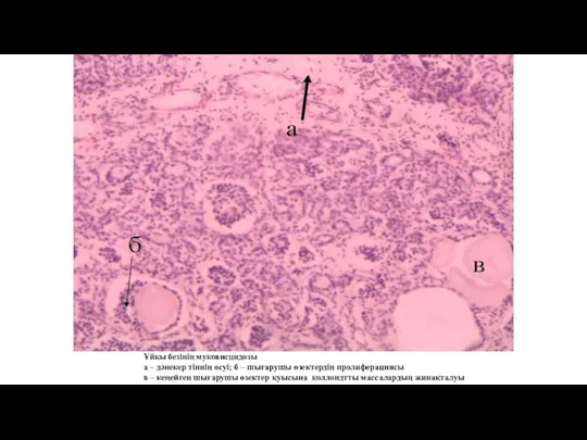 Ұйқы безінің муковисцидозы а – дәнекер тіннің өсуі; б – шығарушы өзектердің
