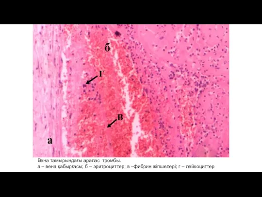 Венa тамырындағы аралас тромбы. а – вена қабырғасы; б – эритроциттер; в