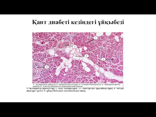 Қант диабеті кезіндегі ұйқыбезі 1-Экзокринді ацинустар; 2 –кан тамырлары ; 3- Лангерганс