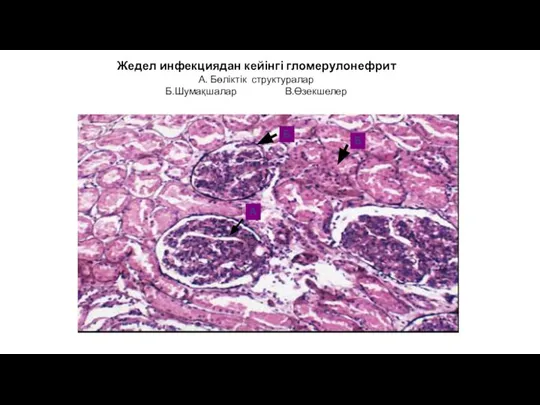 Жедел инфекциядан кейінгі гломерулонефрит А. Бөліктік структуралар Б.Шумақшалар В.Өзекшелер А Б В