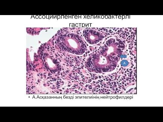 Ассоциирленген хеликобактерлі гастрит А.Асқазанның безді эпителиінің нейтрофилдері А
