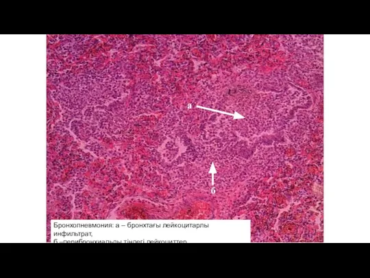 Бронхопневмония: а – бронхтағы лейкоцитарлы инфильтрат, б –перибронхиальды тіндегі лейкоциттер а б