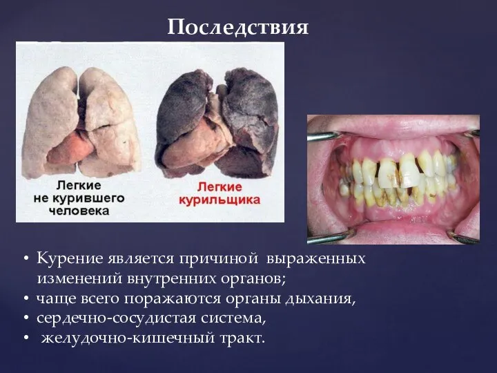 Последствия Курение является причиной выраженных изменений внутренних органов; чаще всего поражаются органы