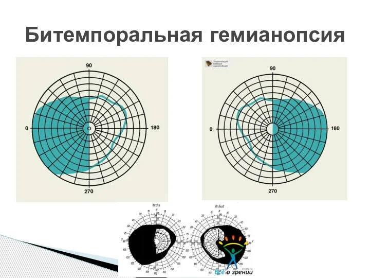 Битемпоральная гемианопсия