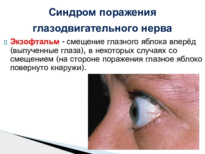 Экзофтальм - смещение глазного яблока вперёд (выпученные глаза), в некоторых случаях со