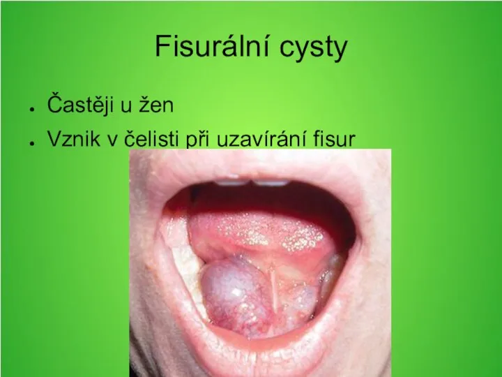 Fisurální cysty Častěji u žen Vznik v čelisti při uzavírání fisur