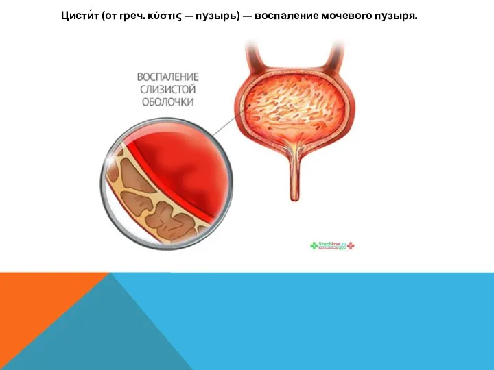 Цисти́т (от греч. κύστις — пузырь) — воспаление мочевого пузыря.