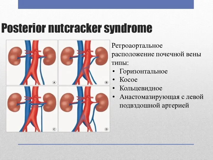 Posterior nutcracker syndrome Ретроаортальное расположение почечной вены типы: Горизонтальное Косое Кольцевидное Анастомазирующая с левой подвздошной артерией