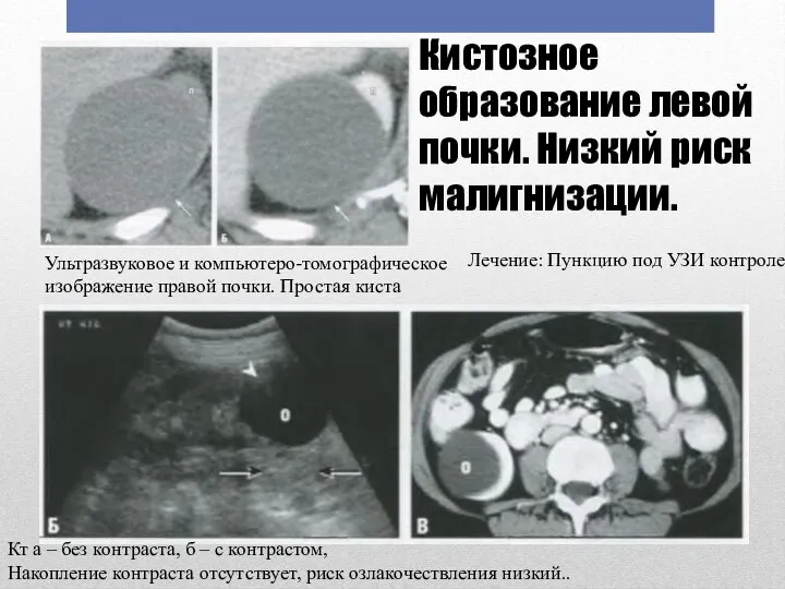 Ультразвуковое и компьютеро-томографическое изображение правой почки. Простая киста Кт а – без