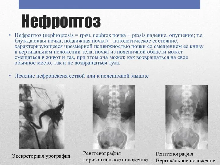 Нефроптоз Нефроптоз (nephroptosis = греч. nephros почка + ptosis падение, опущение; т.е.