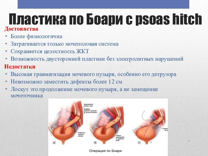 Пластика по Боари с psoas hitch Достоинства Более физиологична Затрагивается только мочеполовая