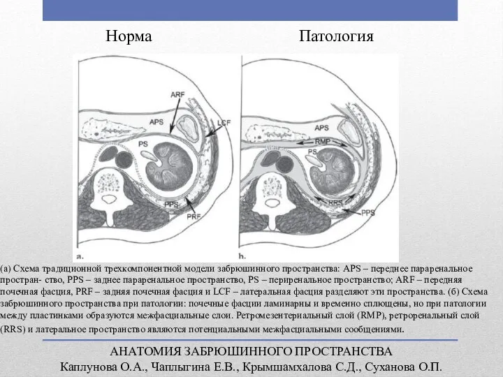 АНАТОМИЯ ЗАБРЮШИННОГО ПРОСТРАНСТВА Каплунова О.А., Чаплыгина Е.В., Крымшамхалова С.Д., Суханова О.П. Норма