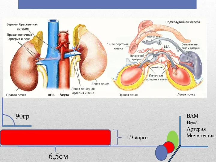 6,5см 90гр 1/3 аорты ВАМ Вена Артерия Мочеточник