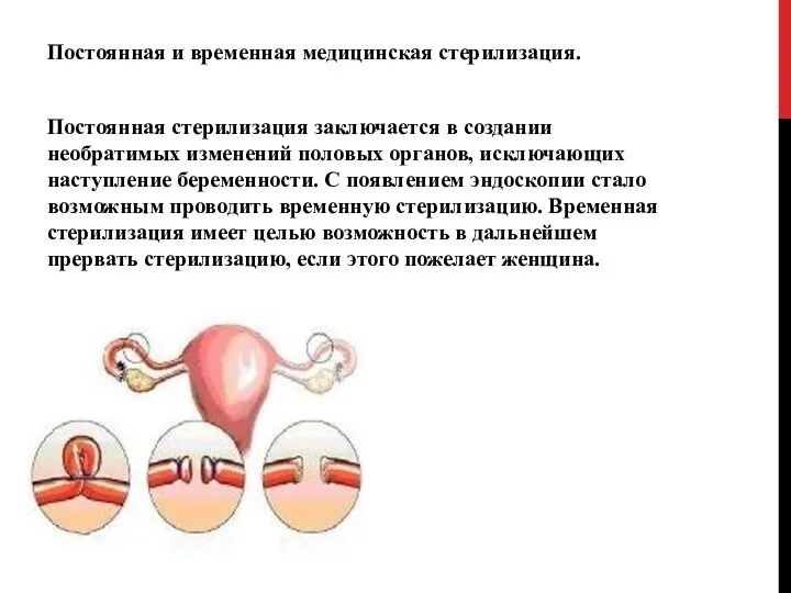 Постоянная и временная медицинская стерилизация. Постоянная стерилизация заключается в создании необратимых изменений