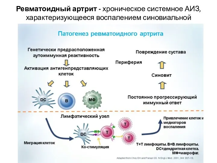 Ревматоидный артрит - хроническое системное АИЗ, характеризующееся воспалением синовиальной оболочки суставов