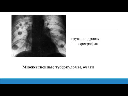 Множественные туберкуломы, очаги крупнокадровая флюорография